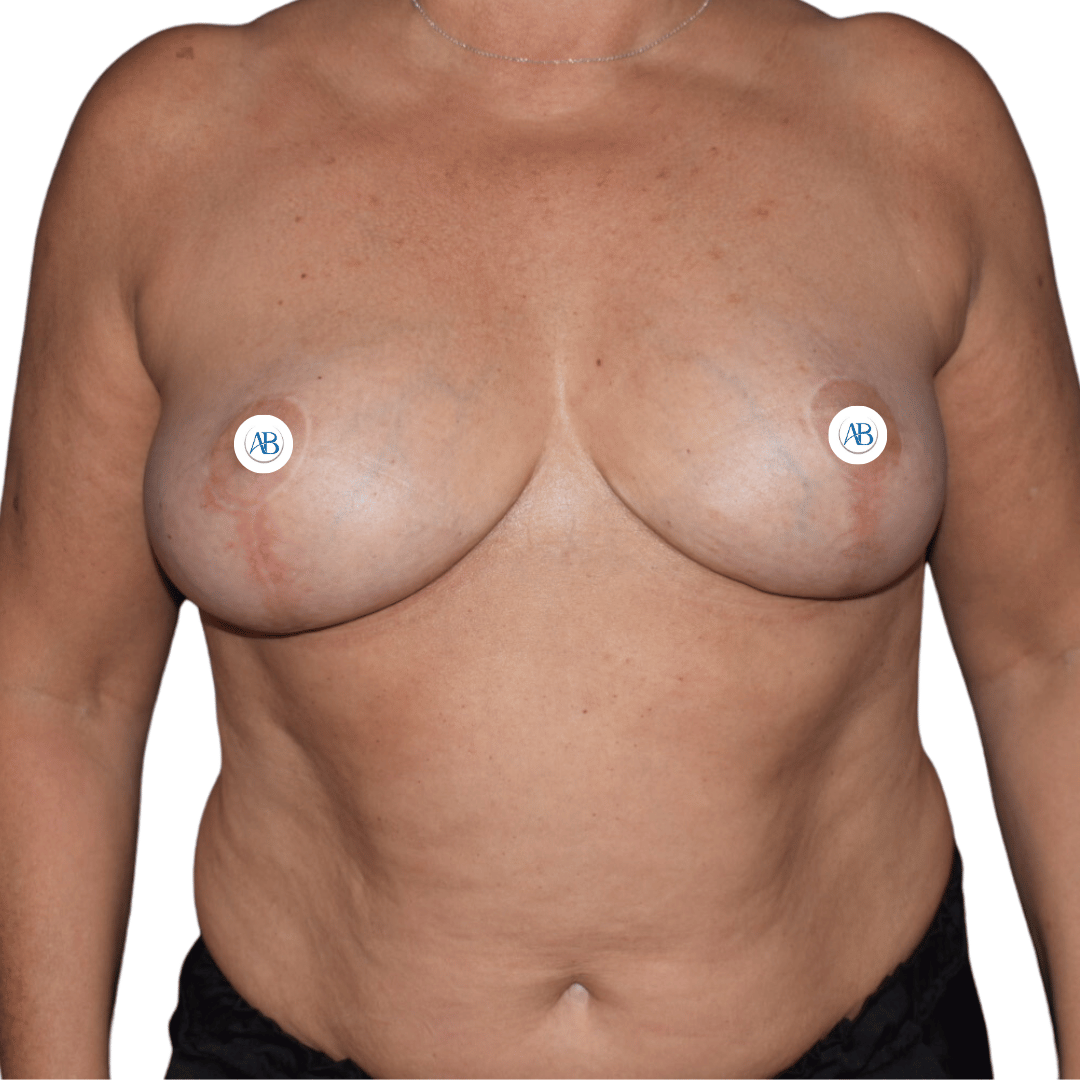 opinion cirujano bilabo